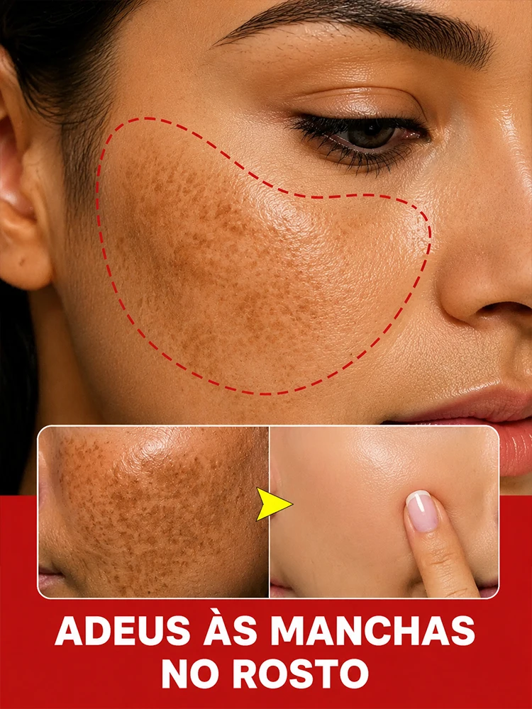 Koreanisches Aufhellungs-Serum gegen Sommersprossen, Kraftvoller Melanin-Blocker, Entfernt Sonnenflecken und Altersflecken, Reduziert Pigmentflecken, Strahlende Haut Tag & Nacht Gesichtspflege
