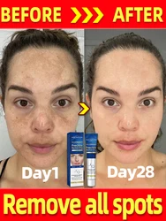 Melasma Freckle Creme para Rosto, Remover sardas, Manchas escuras