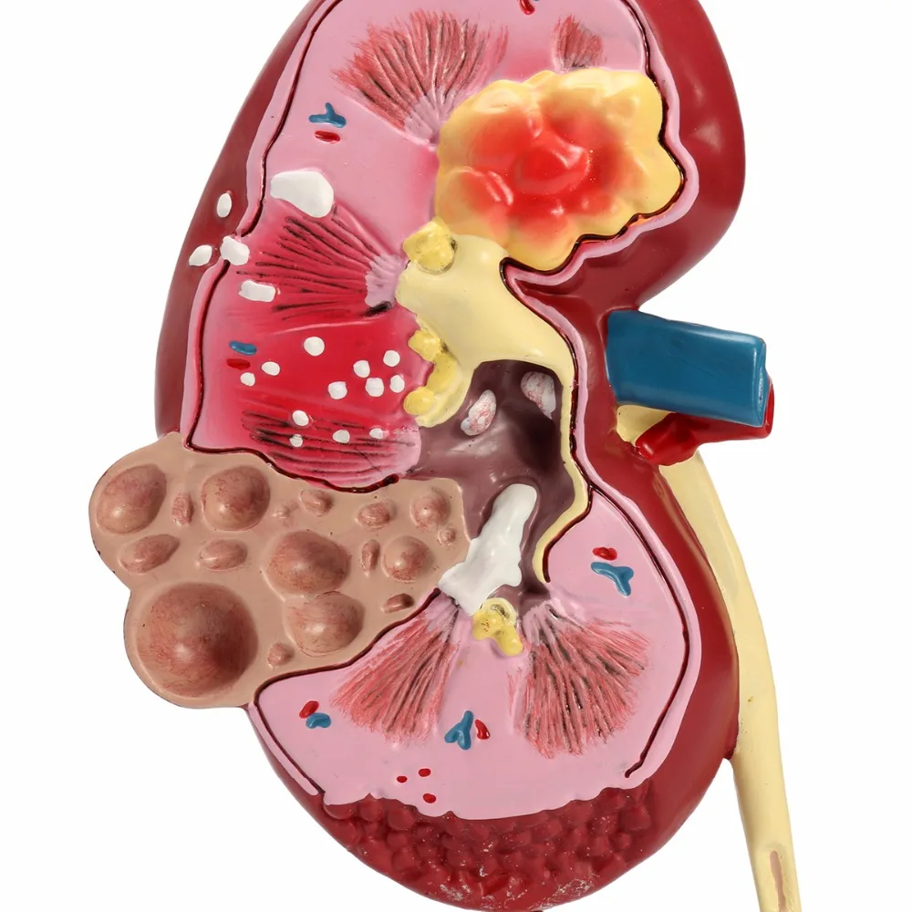 Patologias renais modelo anatomia do corpo humano réplica de rim doente para médicos escritório ferramenta educacional gpi anatômicas