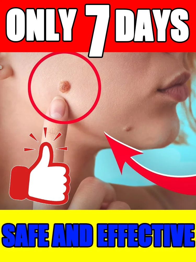 

Painless wart removal laser pen: Gentle energy removes warts, reducing skin irritation and discomfort