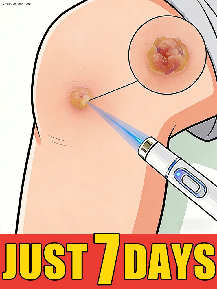 Using The Brand New Generation-3 Laser Says Goodbye To all warts In 7 Day