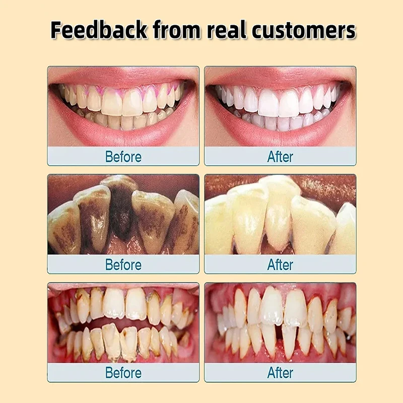 Removedor De Creme Dental De Pedra Dentária, Clareamento, Remove O Mau Hálito, Cuidados De Limpeza Dental