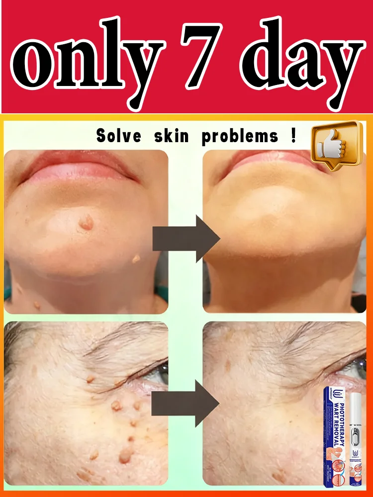 

ʙʟᴜᴇ ʟɪɢʜᴛ ᴘᴇɴ sᴏʟᴠᴇ ᴡᴀʀᴛs, ʜᴏᴛ sᴀʟᴇ ᴡᴀʀᴛ ᴄᴀʀᴇ ᴛᴏᴏʟs