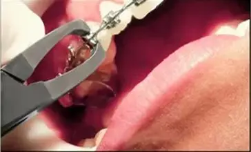 

Dental Anterior Bracket Removal Pliers Stainless Steel Orthodontic Forceps for Cutting Adhesive Remnants Dentist Tool