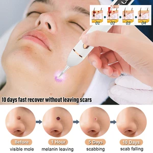 8ベストセールスモールリムーバー-4