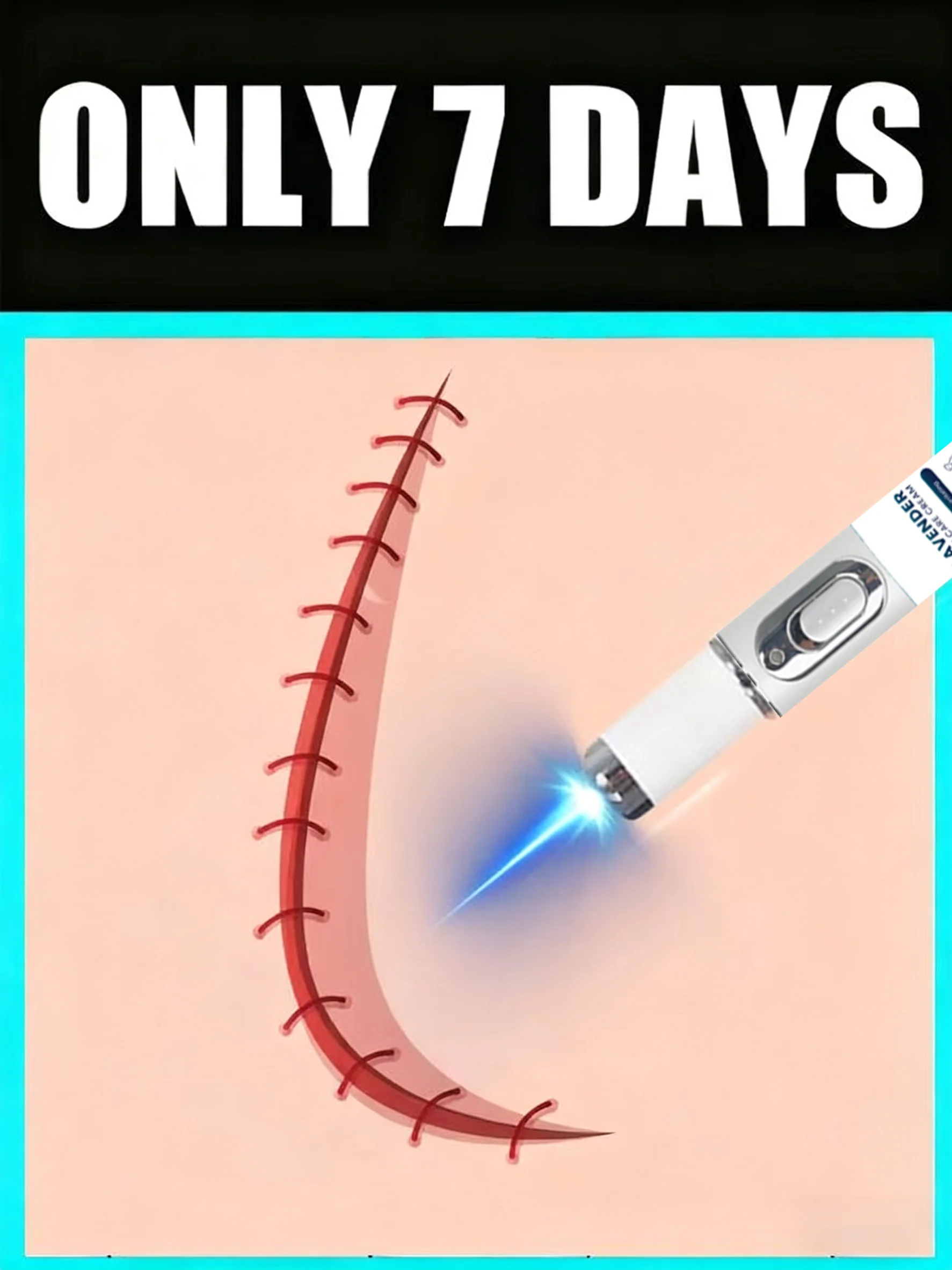 

Portable Laser Pen: Repair Post-Pregnancy Stretch Marks Anywhere