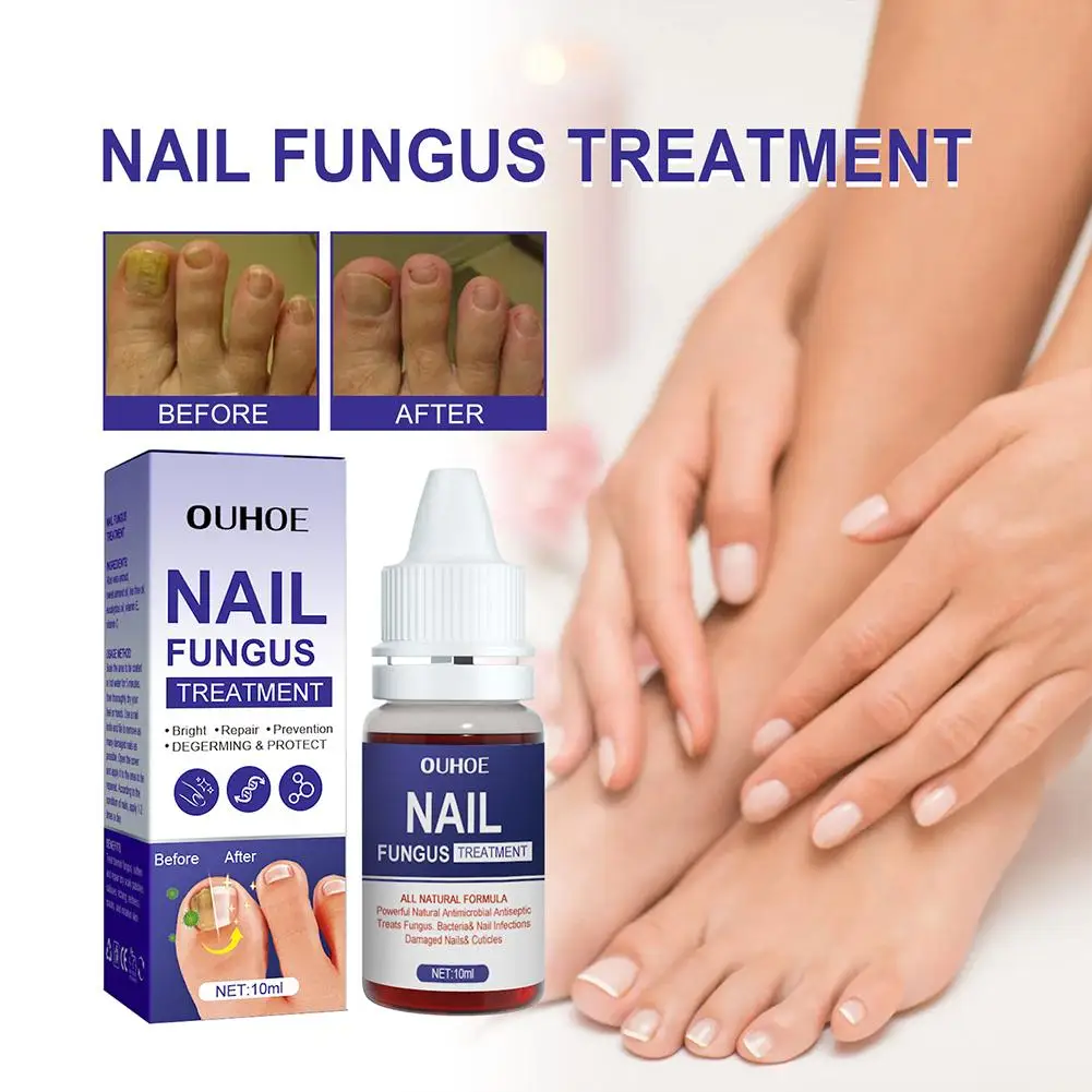 Sérum de traitement des champignons des ongles, liquide de réparation des pieds, Anti-élimination des ongles, Gel d'infection, onychomycose, Paronychia, 10ml, D5D2