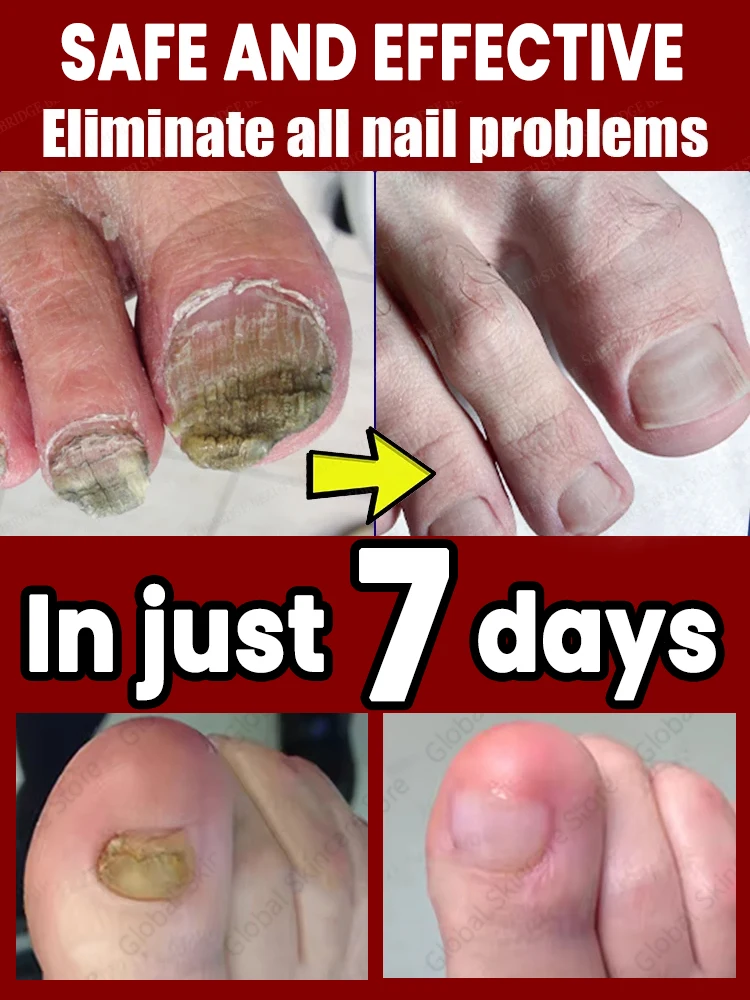 

2025 The latest technology blue laser eliminates fungi and restores healthy nails