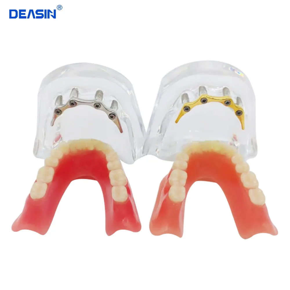 1 pc x high quality Resin Coverage dental implant model dentures Removable teeth model for dentist study Deasin