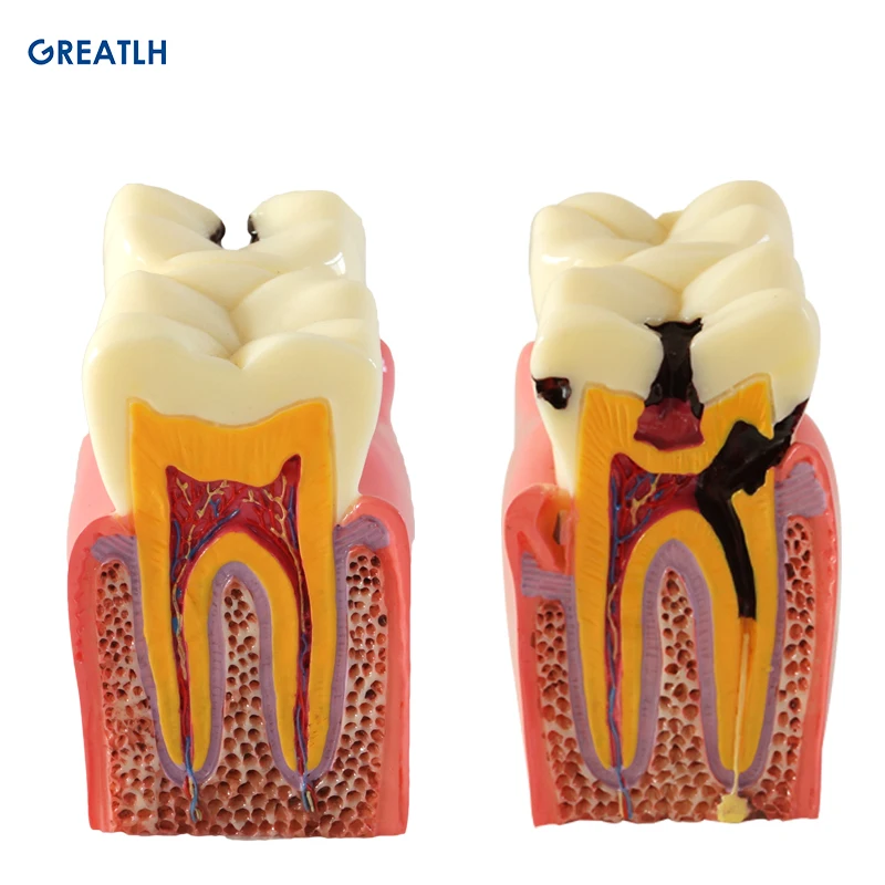 Dental Teach Implant Analysis Crown Bridge Removable Model Dental Demonstration Teeth Model