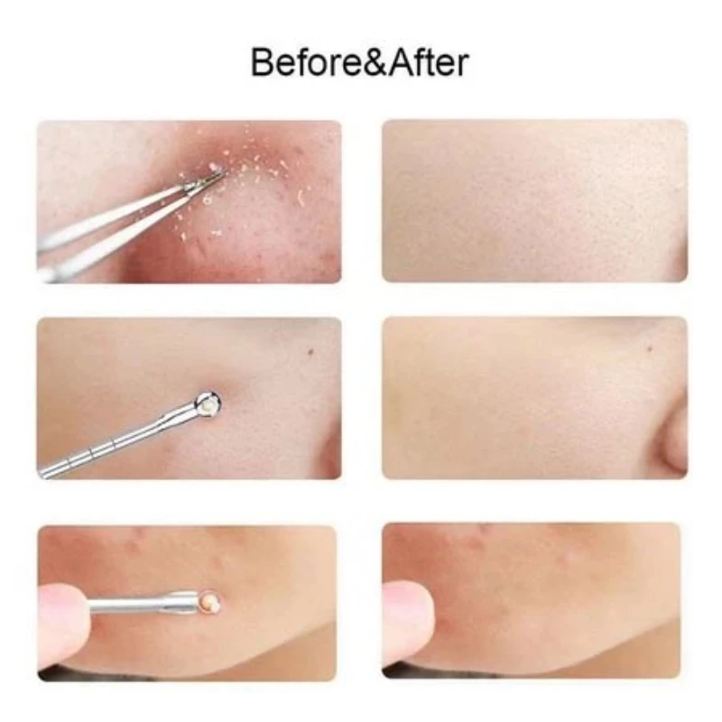 Acne Naald Verwijderen Mee-eter Smet Puistje Zwarte Stippen Mee-eter Extractor Acne Naald Gezichtsreiniger Huidverzorging Gereedschap