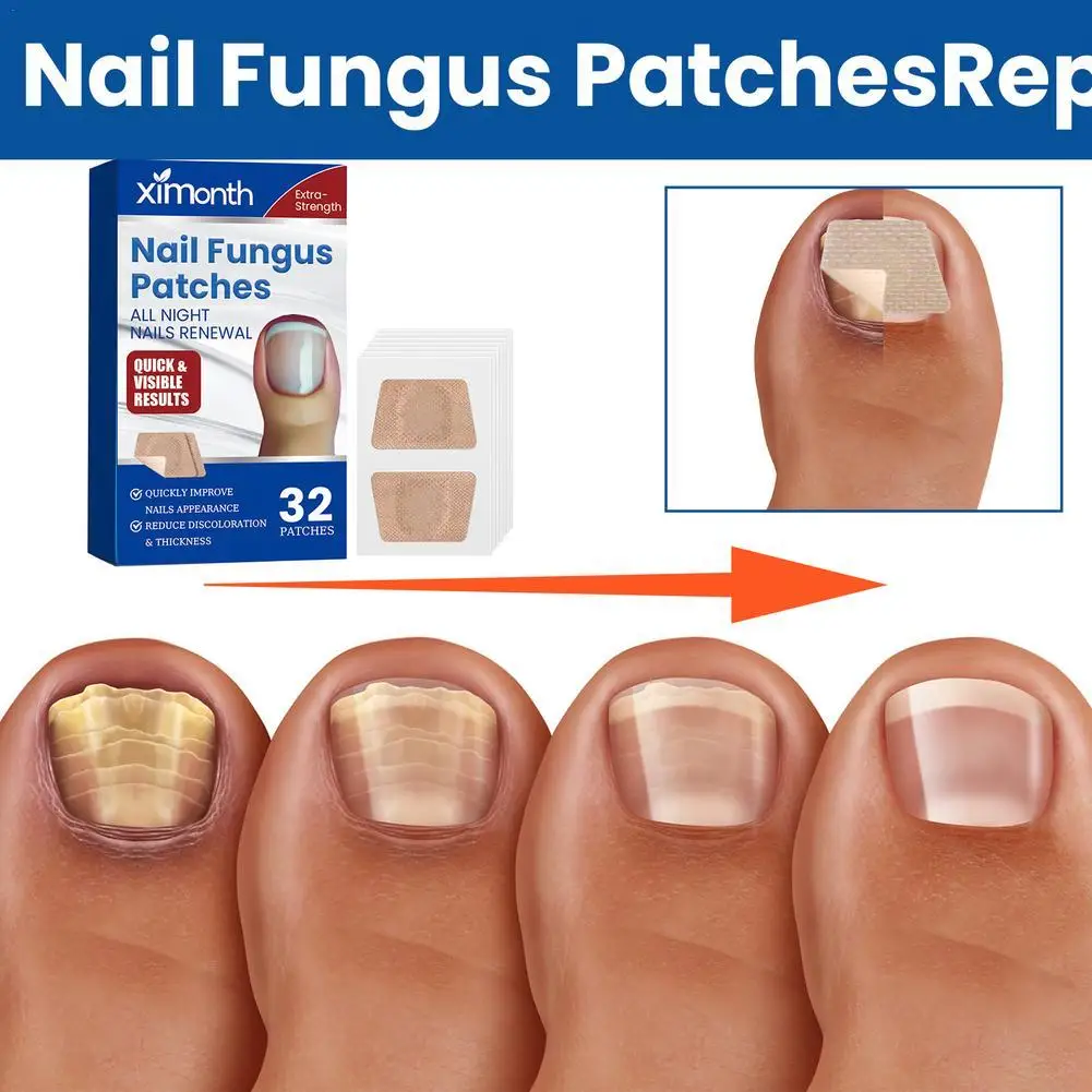 

Nail Repair Patches Toenail Fungus Patch Sticky Toenail Care Nail Ingrown Correction Sticker Paronychia Nail Treatment 32 Patch