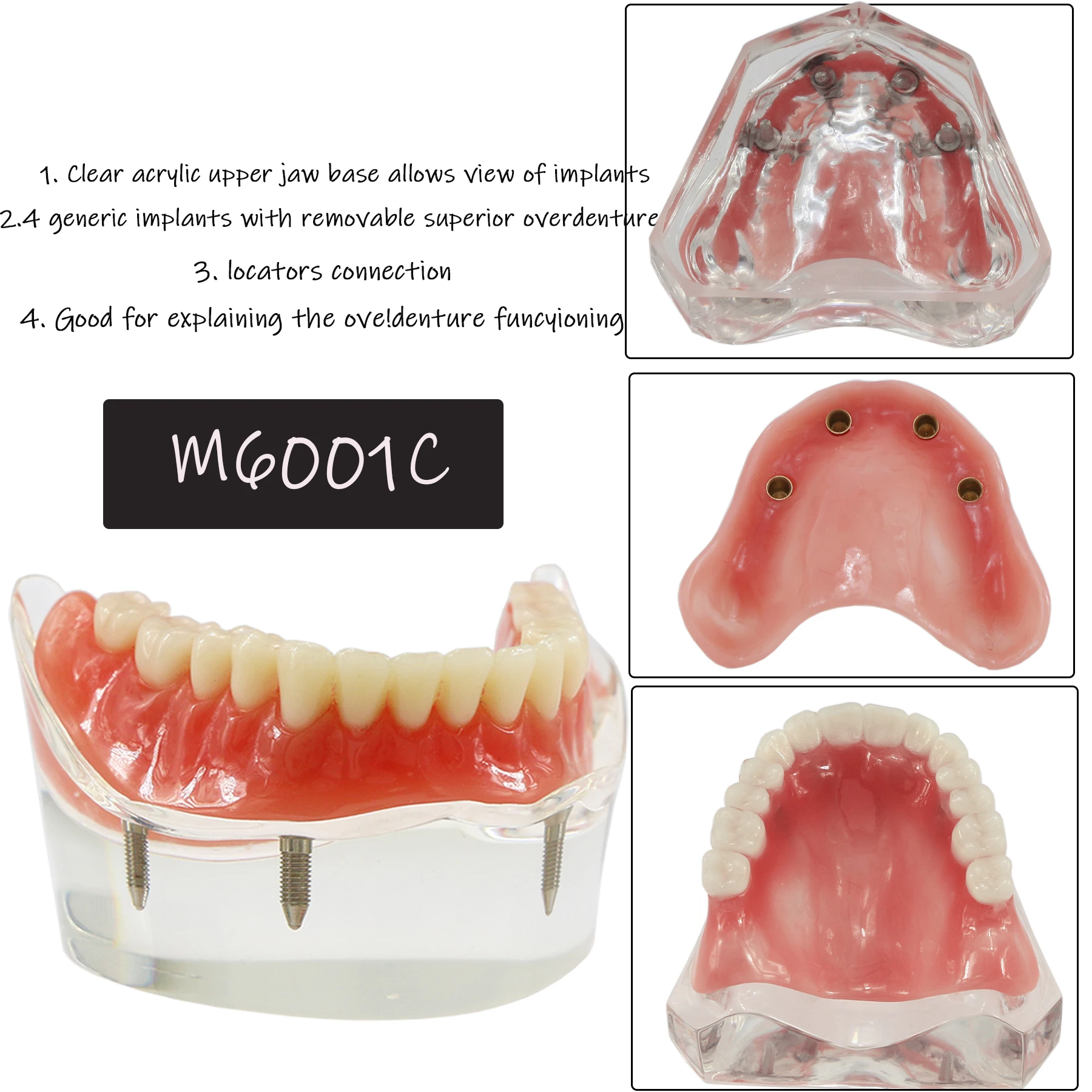 Dental 4 Implant Teeth Model Demo Removable Overdenture Restoration Upper M6001C