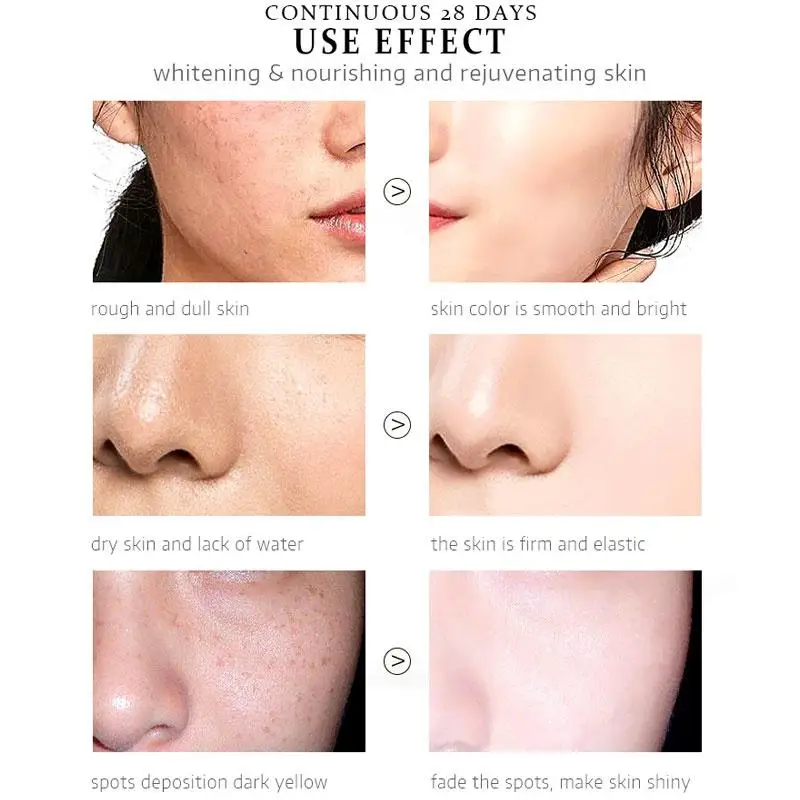 Crema facial blanqueadora para pecas, crema para eliminar Melasma, manchas oscuras, melanina, nicotinamida, hidratante, iluminadora, cuidado de la piel