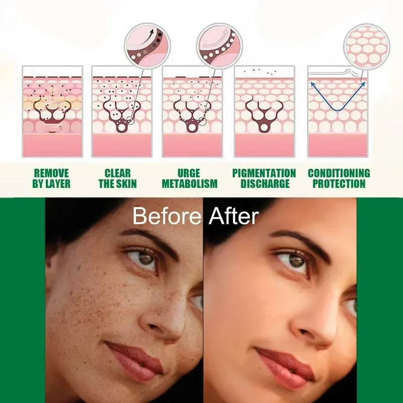 Effective Whitening Freckle Essence Remove Dark Spots Anti Melasma Fade Pigmentation dull repair Brighten facial skin Cream