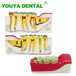 Dental Teeth Anatomical Model Right Posterior Tooth Cross Section Decomposition Model Dentistry Teaching Demonstration Models