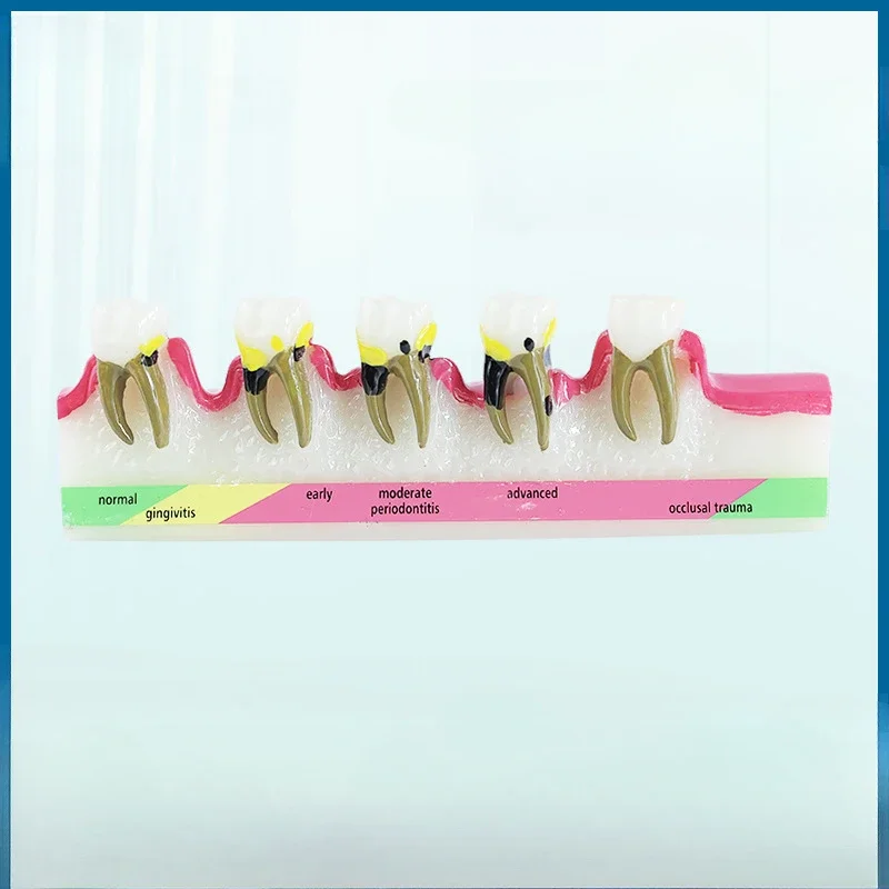 Periodontitis Model Resin Adult Periodontal Evolution Tooth Model Oral Dental Demonstration Teaching