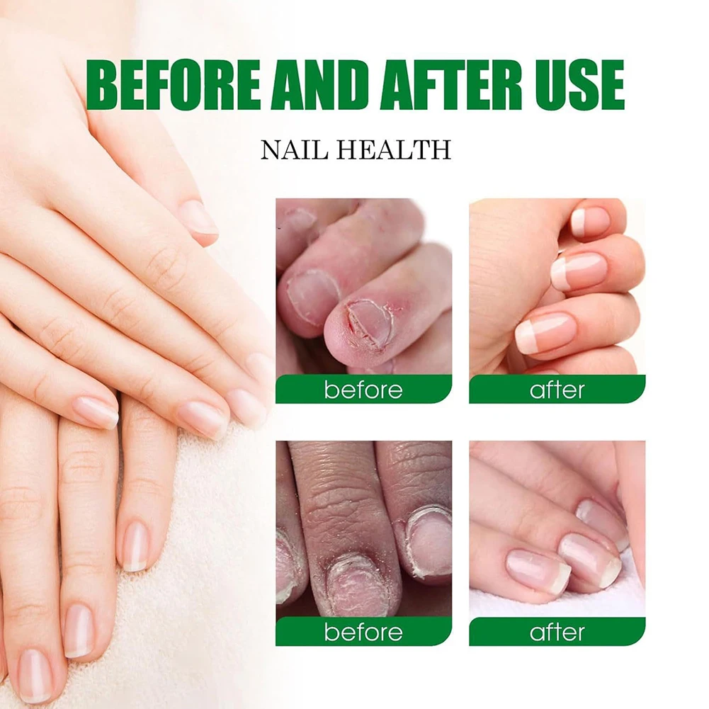 ครีมทามือไม่เหนียวเหนอะหนะบำรุงมือและเท้าเซรั่มดูแลเล็บสำหรับฤดูหนาวเนื้อเจลแห้งดูดซึมง่ายการรักษาเชื้อราที่เล็บ 20 มล