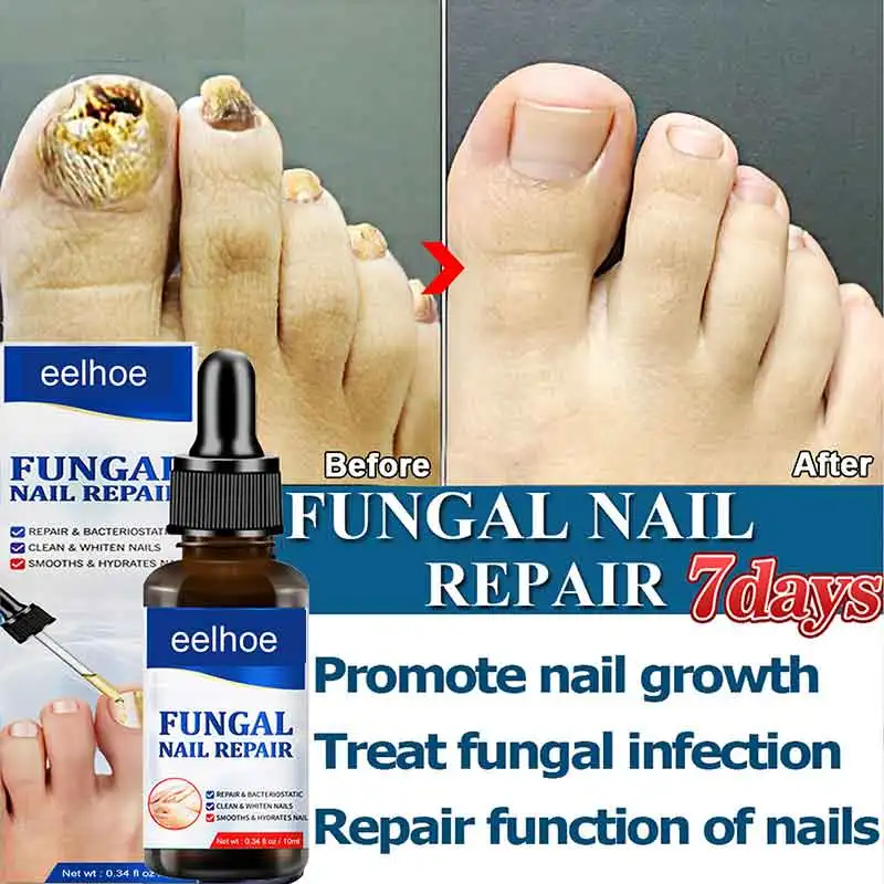 Fungal Nail Treatment Oil Foot Repair Essence Toe Nail Fungus Removal Gel Anti Infection Cream Fungal Nail Removal 10ML