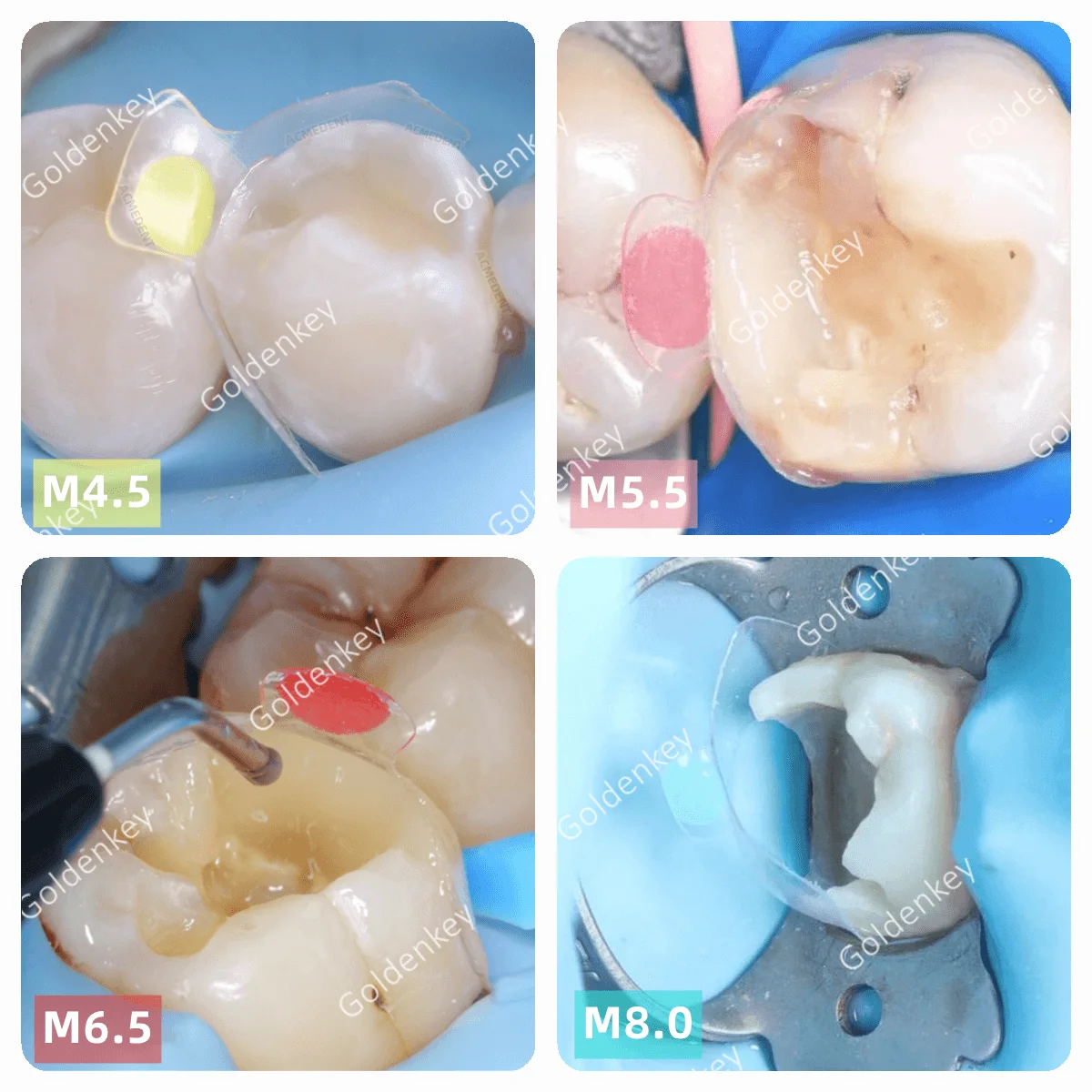 Dental Clear Matrix Posterior Fits Bioclear Transparent BT Matrices Molar Composite Class Restorative 4.5/5.5/6.5/8.0 0.038mm