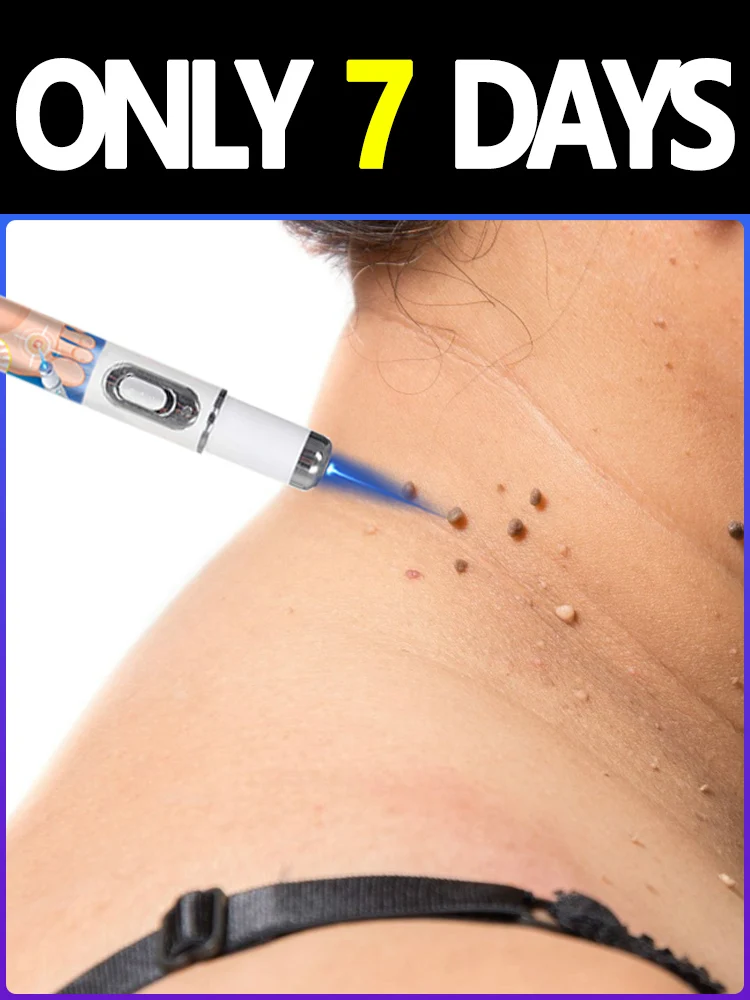 

25 hot selling Blue Laser Solve Wart Tool