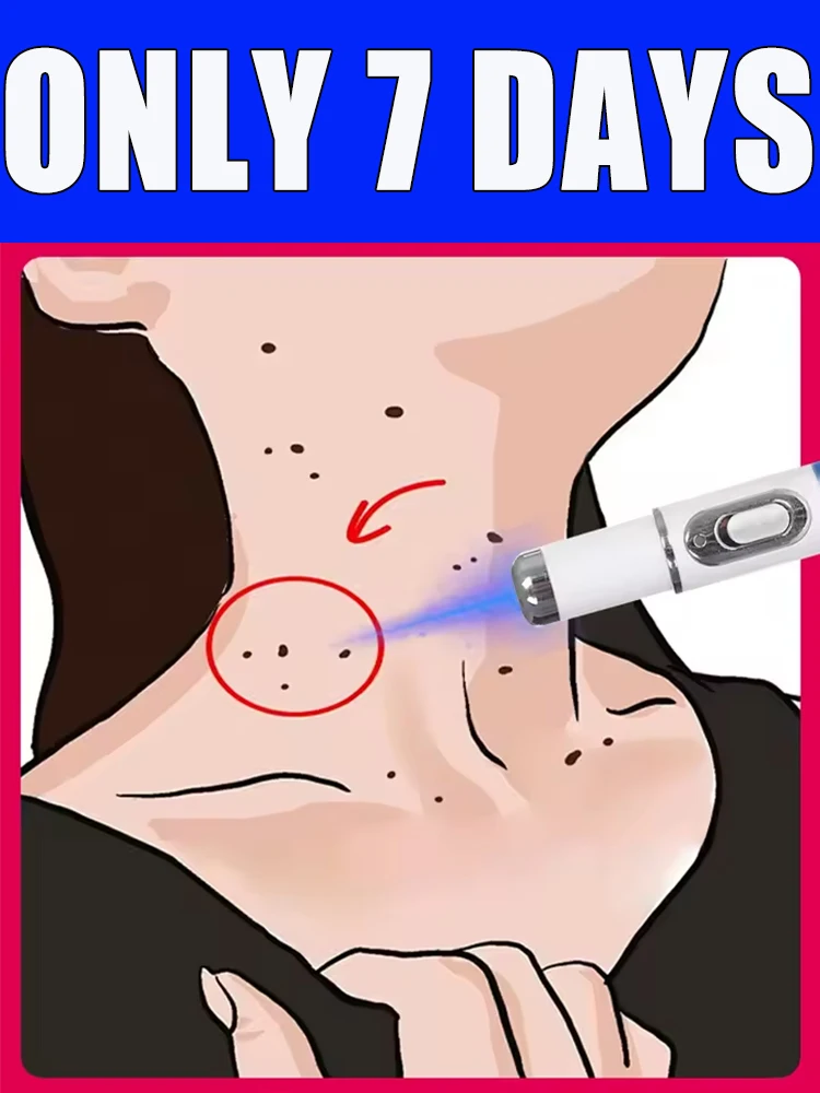 

Blue light wart tool, more discounts on sets