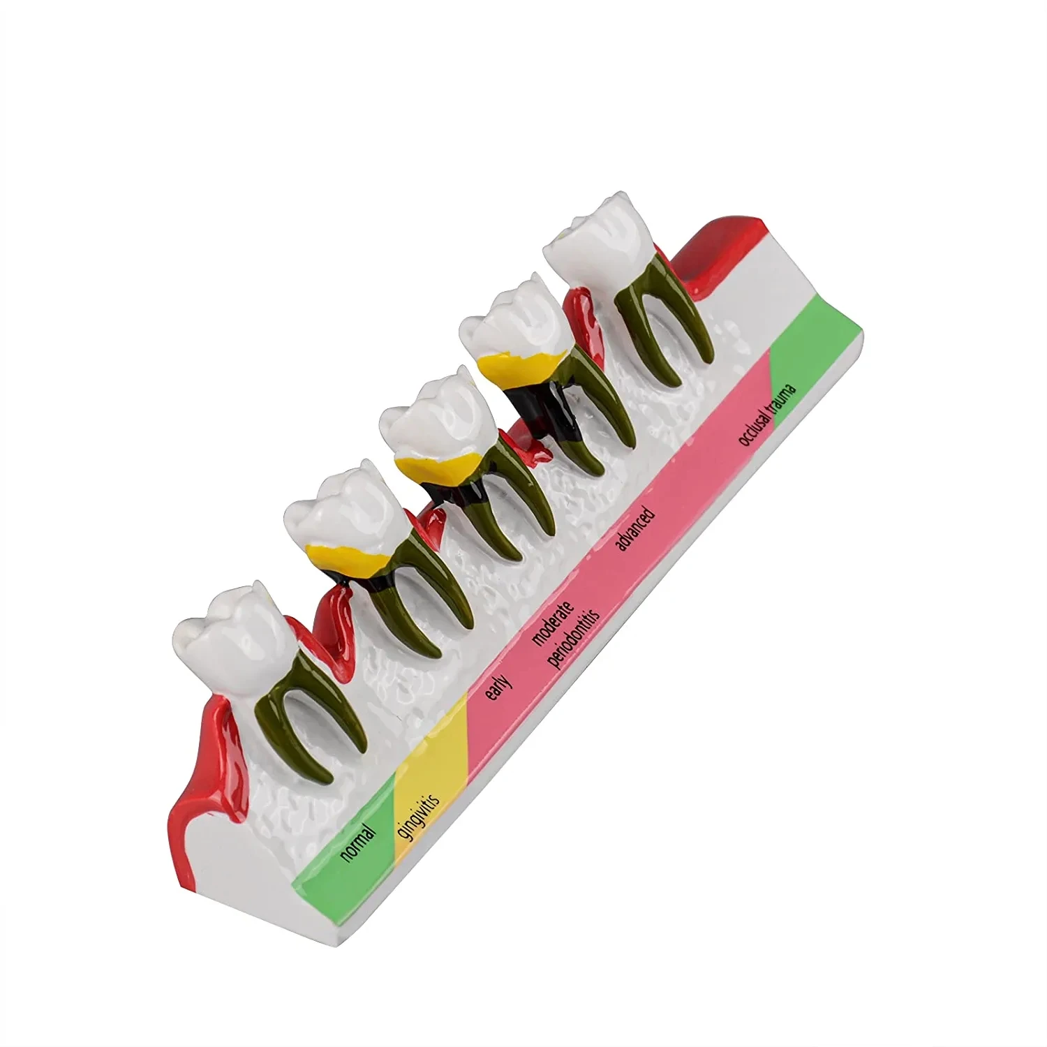 Dental Periodontal Disease Model, Dental Teeth Model for Dental Tooth Anatomy Study, Doctor-Patient and Oral Care Education