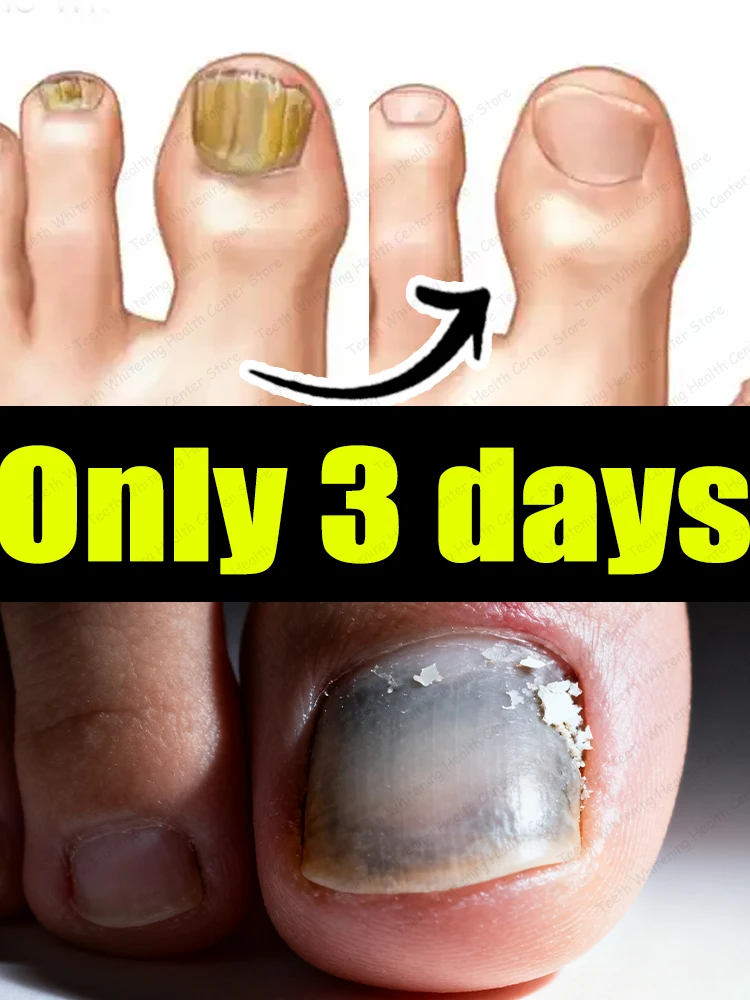 

Новая технология синего света на 2025 год. Используется для ремонта портативного и компактного onychomycosis.