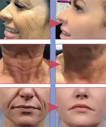 Imagen 2 del producto Retinol crema antiarrugas colágeno antienvejecimiento eliminación instantánea cara cuello arrugas eficiente hidratante reafirmante cuidado de la piel coreano