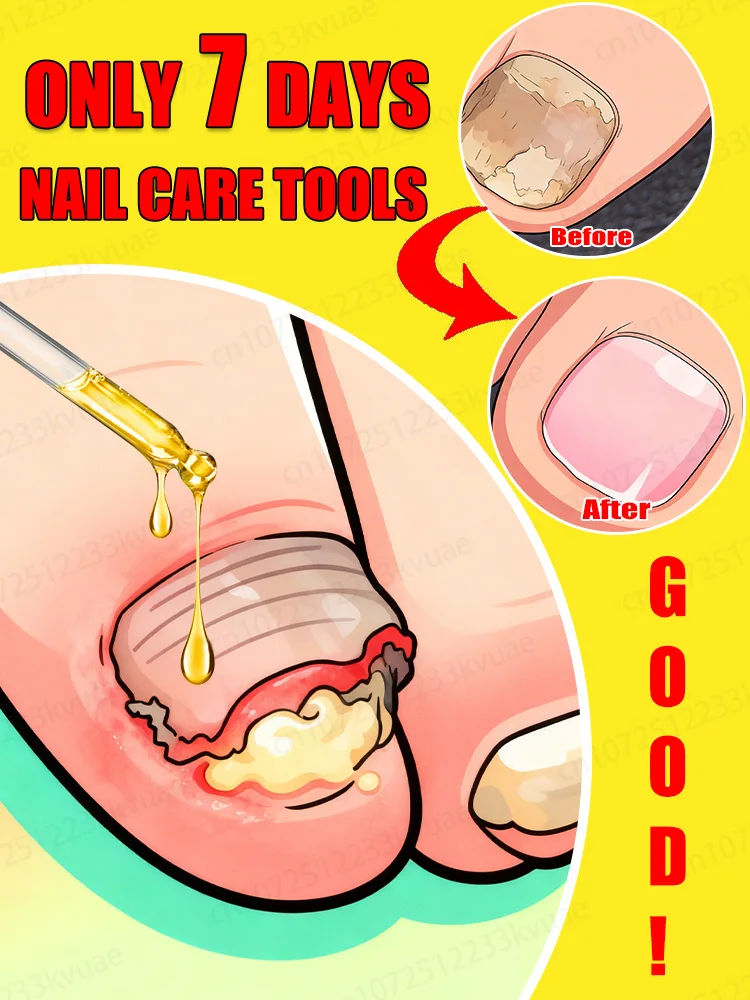 

Qᴜɪᴄᴋ Tʀᴇᴀᴛᴍᴇɴᴛ, Sᴀʏ Gᴏᴏᴅʙʏᴇ ᴛᴏ Fᴜɴɢᴀʟ Nᴀɪʟ Wᴏʀʀɪᴇs