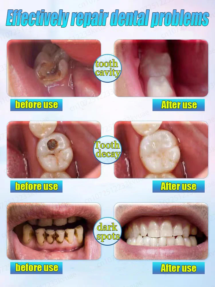 Cavity repair toothpaste, repairs cavities, whitens teeth, freshens breath