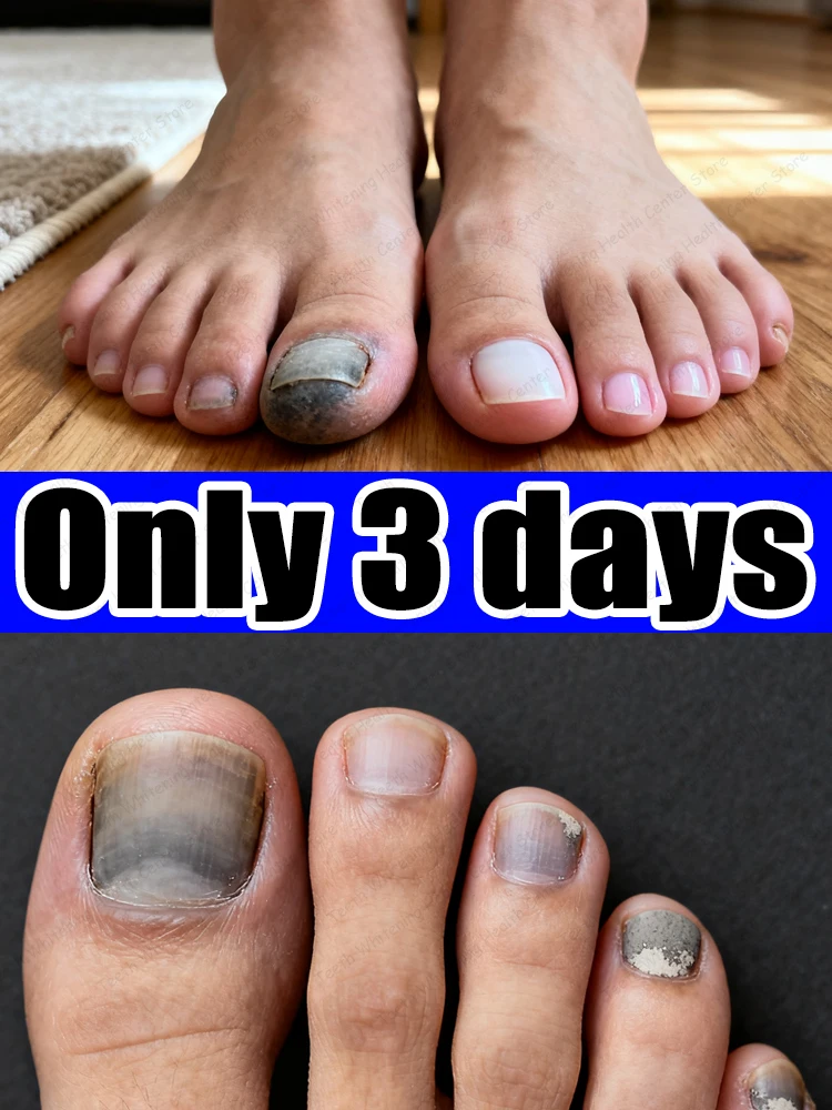 

ᴮˡᵘᵉ ˡⁱᵍʰᵗ ˡᵃˢᵉʳ ᵗʳᵉᵃᵗᵐᵉⁿᵗ ᵖᵉⁿ for ᵗʳᵉᵃᵗⁱⁿᵍ ᵒⁿʸᶜʰᵒᵐʸᶜᵒˢⁱˢone button operation