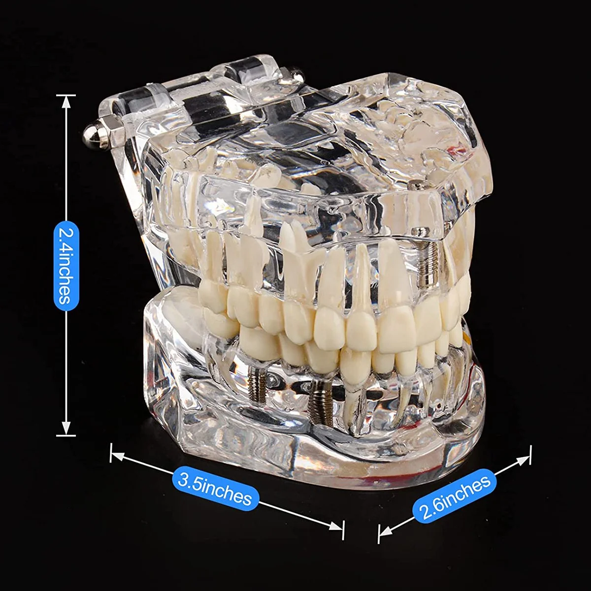 

Transparent Disease Teeth Model with Dental Implant Bridge, Dental Model for Patient and Dental Student Education