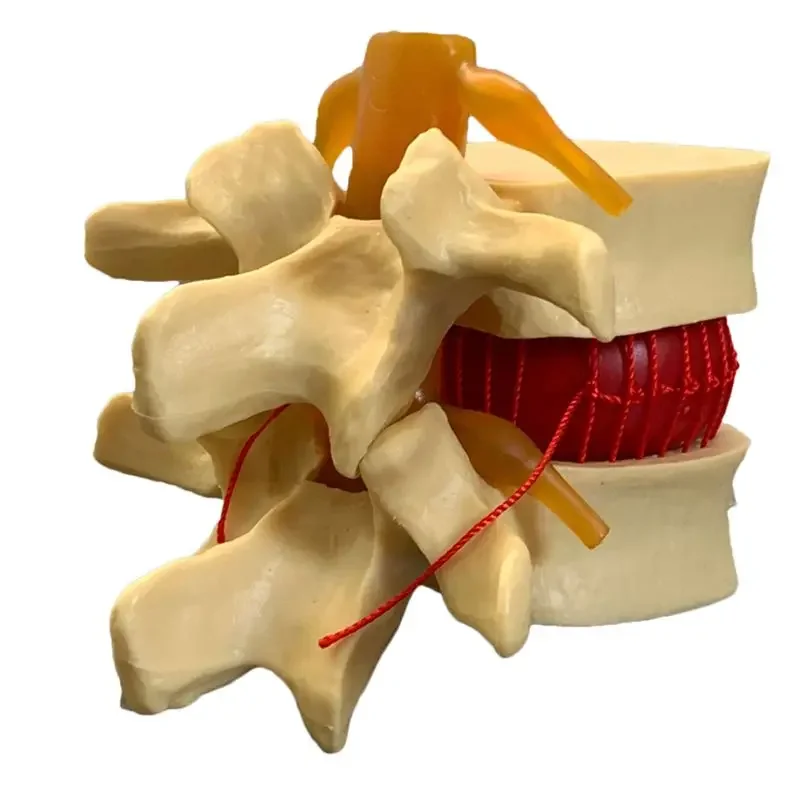 Anatomical Human Lumbar Vertebrae Degenerative Lumbar Disc Herniation Demonstration Model Human Spine Model - White, Yellow