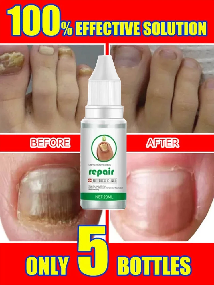 Soro de tratamento de fungos nas unhas, produtos de reparo de fungos dos pés, gel de remoção de cuidados com as mãos e pés, anti-infecção, onicomicose, paroníquia