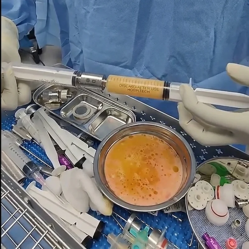 Hydraulic Fat Separator Male Luer Lock to Luer lock Fat Transfer Adaptors for Nano Fat Grafting