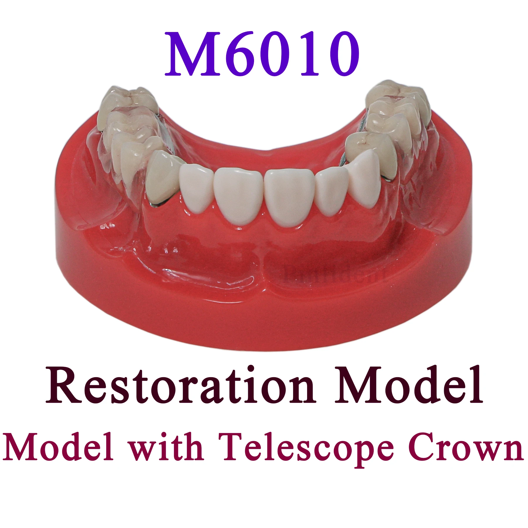 Dental Typodont Restoration Teeth Implant Model Telescope Crown  Orthodontic Restoration Model M6010