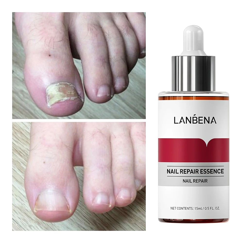15 مللي مصل إصلاح الأظافر علاج الأظافر إزالة فطار الأظافر الفطري تو سطع مغذي اليد القدم العناية بالبشرة