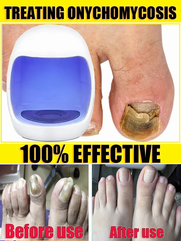 Fungal Nail Laser Onychomycosis Fungus Nails Repair Fast