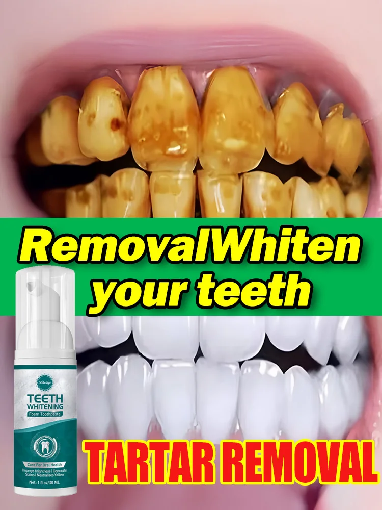 

Teeth Whitening Tartar Removal
