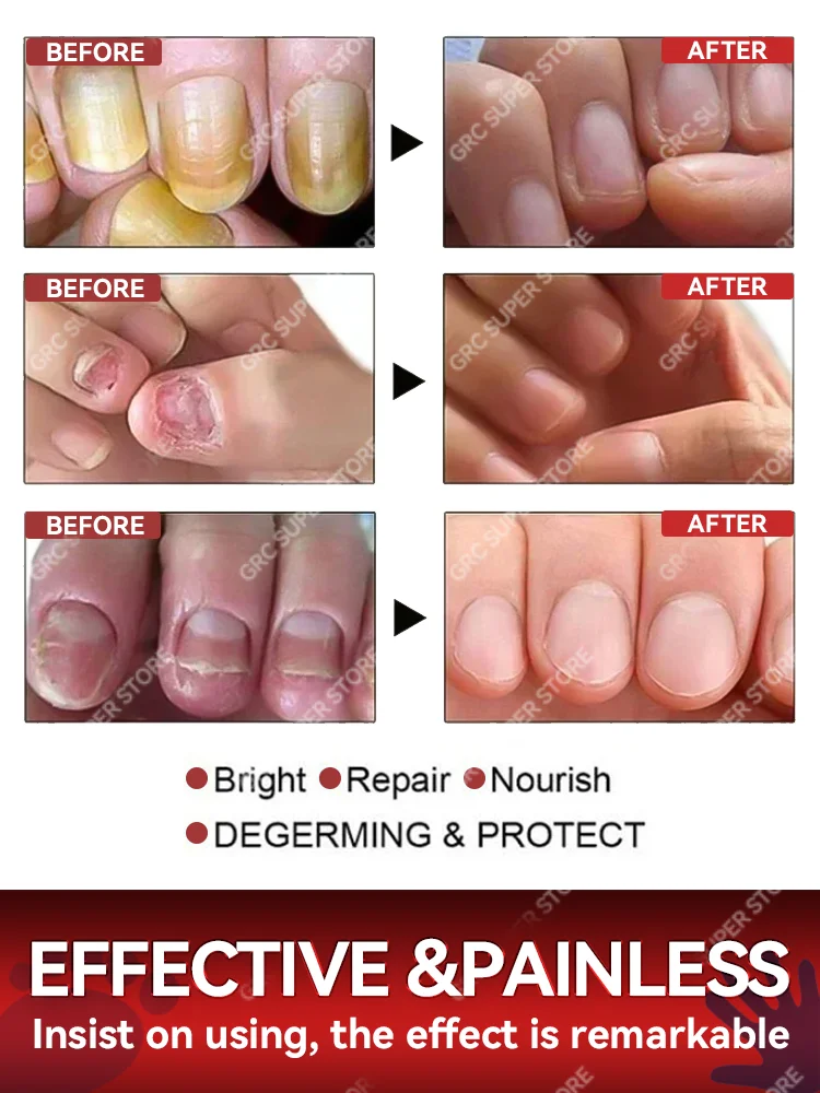 เซรั่มเท้าด้วยน้ํามันหอมระเหย onychomycosis ประสบการณ์การซ่อมแซม 7 วัน