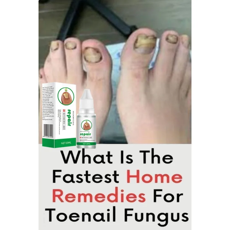 forte-fungo-per-unghie-piedi-unghie-riparazione-cura-anti-infezione-rimozione-fungine-delle-dita-dei-piedi-nuovo