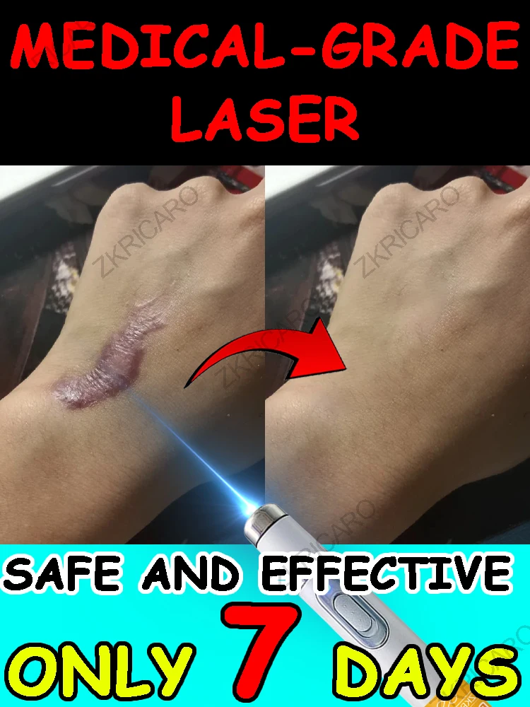 Dispositif laser de qualité médicale, économisez votre peau!