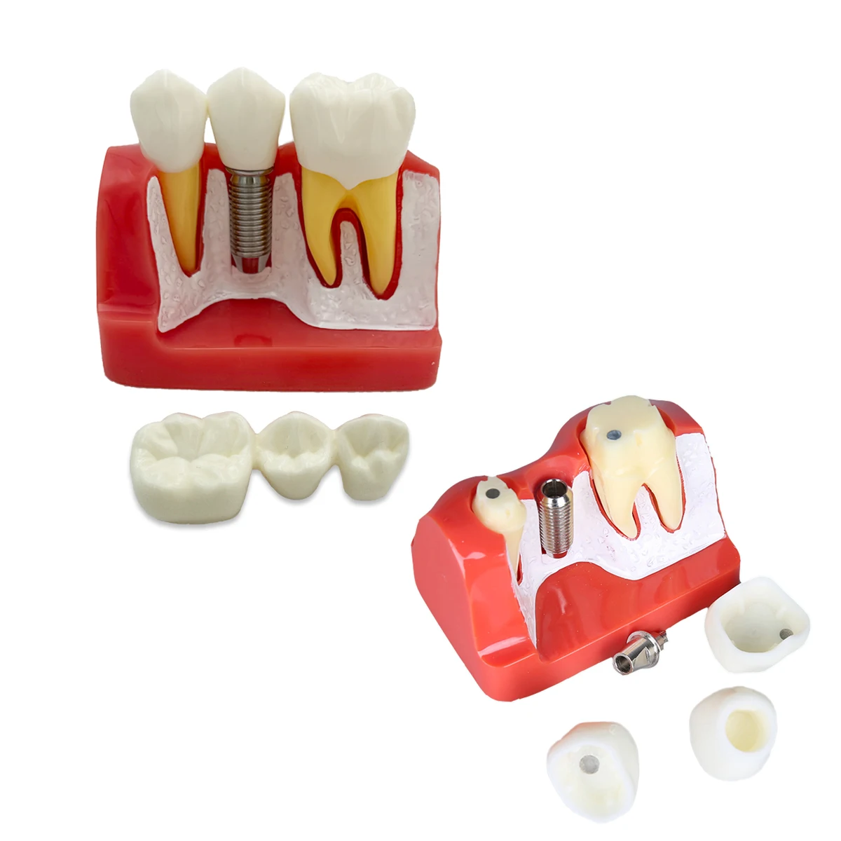 

Dental Model Implant Demonstration Dental Teach Implant Analysis Crown Bridge Removable Models For Dentist Student Training Tool