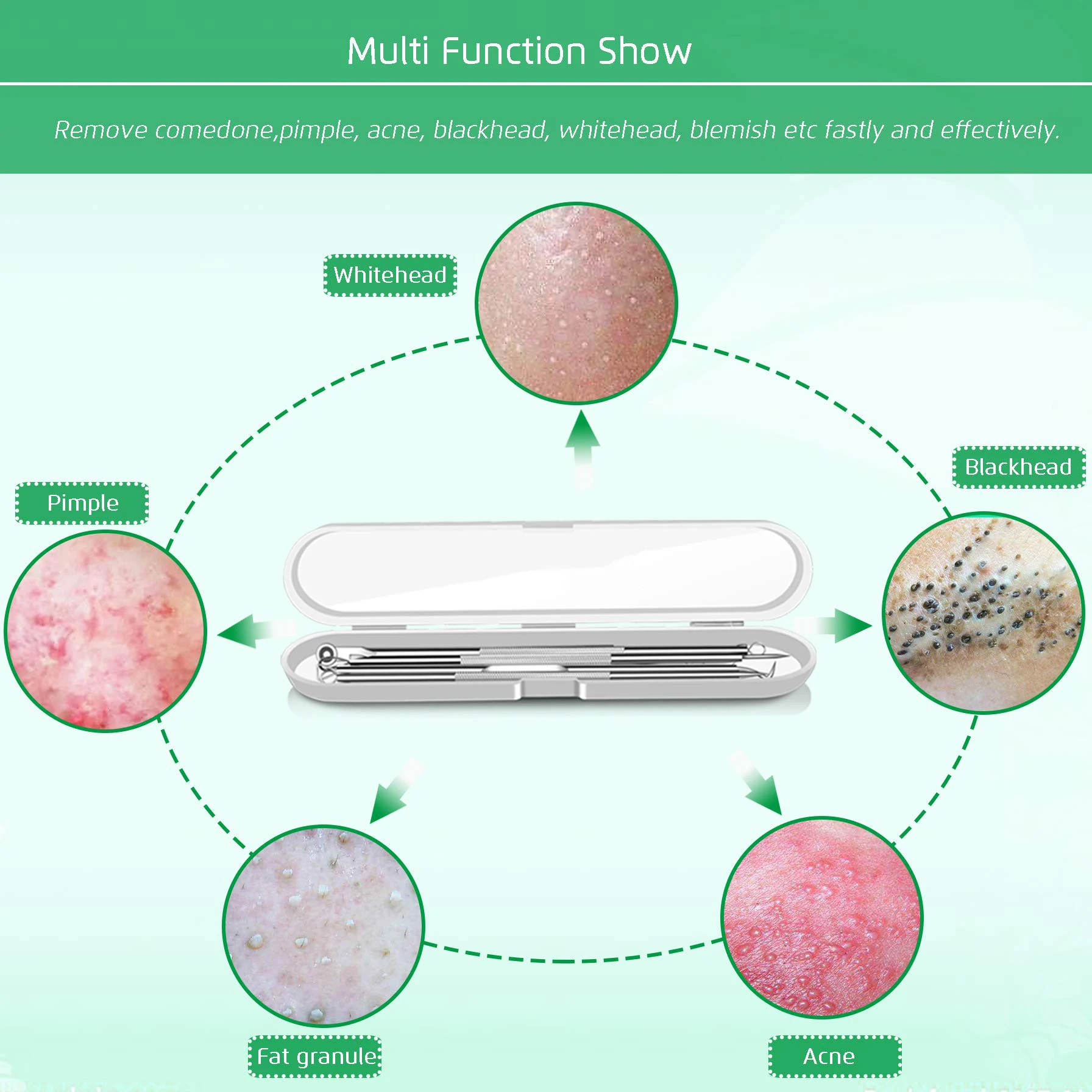 Estrattore di comedoni per la rimozione di punti neri da 5 pezzi, kit di pinzette per punti neri curvi, anche per la rimozione delle imperfezioni dell'acne con brufoli in acciaio inossidabile professionale