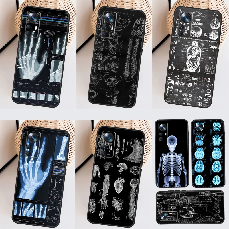 Radiological Human Organs Skeleton Case For Xiaomi 13 13T Pro 12T 11T 12 Lite 12X POCO X3 X5 Pro X4 F4 GT M5 M5s F3 F5 Funda