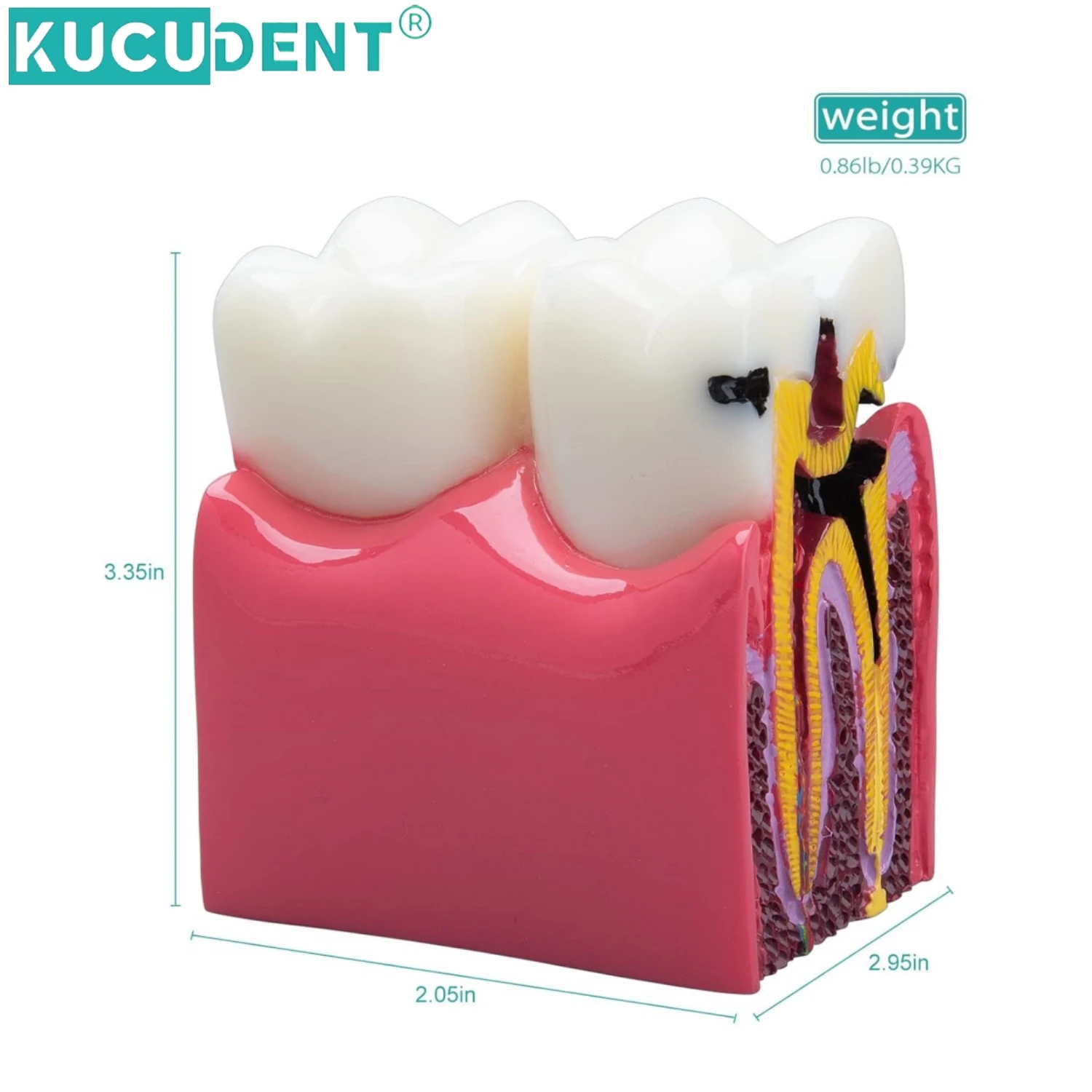 Dental Caries Comparation Study Models 6 Times Teeth Model Decay Demonstration Model Dentistry Lab Anatomy Training Model