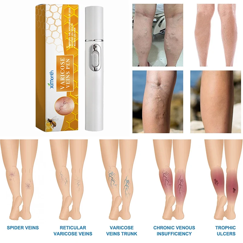 Varicose Veins Laser Therapy Pen Improves Moderate Varicose Vein Relieve Leg Pain Improve Blood Circulation For Men And Women