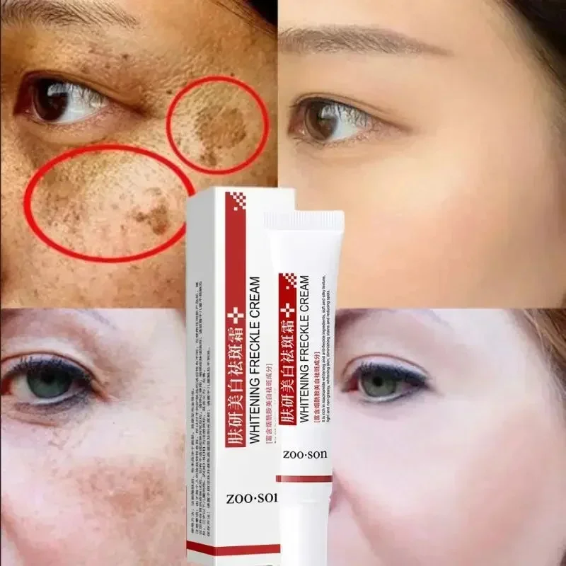 Freckle Removing Cream Women Face Quick Dark Spots Pigmentation Remove Whitening Cream Fade Melasma Brighten Cream for Dark Skin