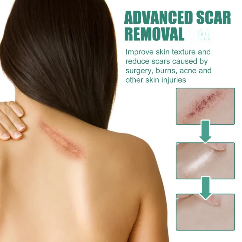 Skin Scar Removal Cream For Burns Surgery Hyperplasia Acne Marks Fade old Scars Stretch Marks Pigment Skin repair Care Gel